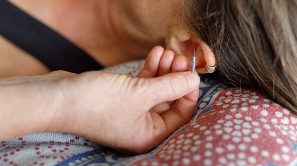 Microsystem acupuncture needle in the ear