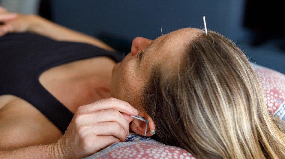 Facial acupuncture needles in the forehead and ear